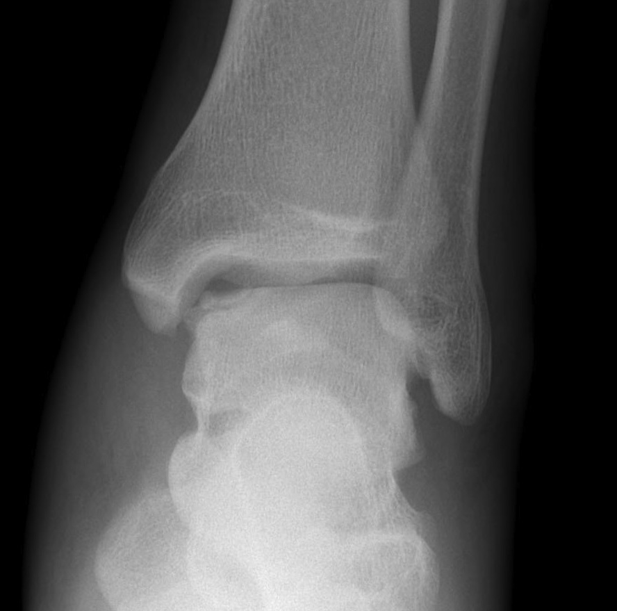 Ankle OCD Medial